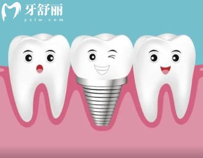 安联种植牙是纯钛吗，安联种植牙是进口还是国产的