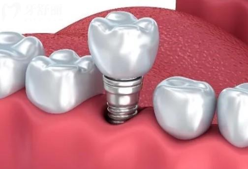 安联种植牙是纯钛吗，安联种植牙是进口还是国产的