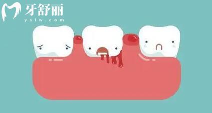 戴牙套刷牙出血是什么原因?该如何改善牙齿出血?jpg