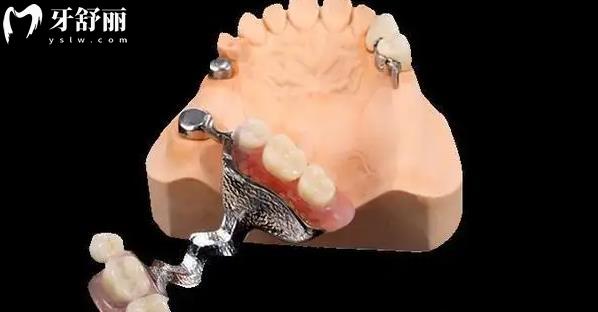昆明现在镶一颗牙多少钱 包含各品牌种植牙牙冠价格表