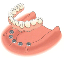 缺了一个牙齿不补回去会有什么影响，有生命危险吗？