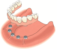 活动假牙和固定假牙以及种植牙的区别和价位对比