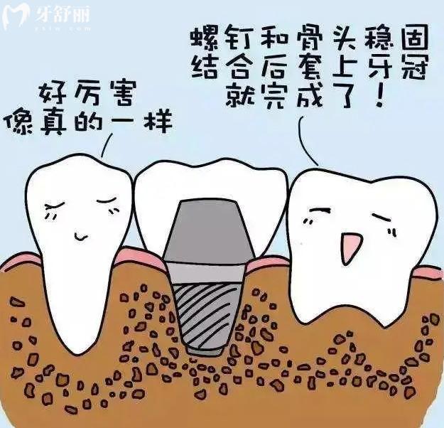 Xive种植牙是哪国的品牌