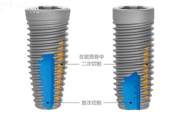 上万一颗的尼斯奥种植牙价格使用的是几级钛 为什么不建议种