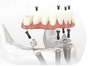 allon4和allon6半全口种植牙区别、优势是什么？.jpg