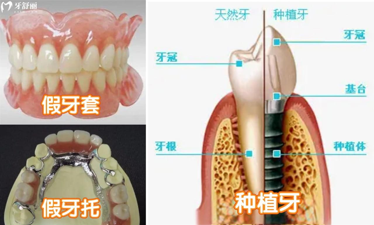 缺失牙不同的补救方法有哪些