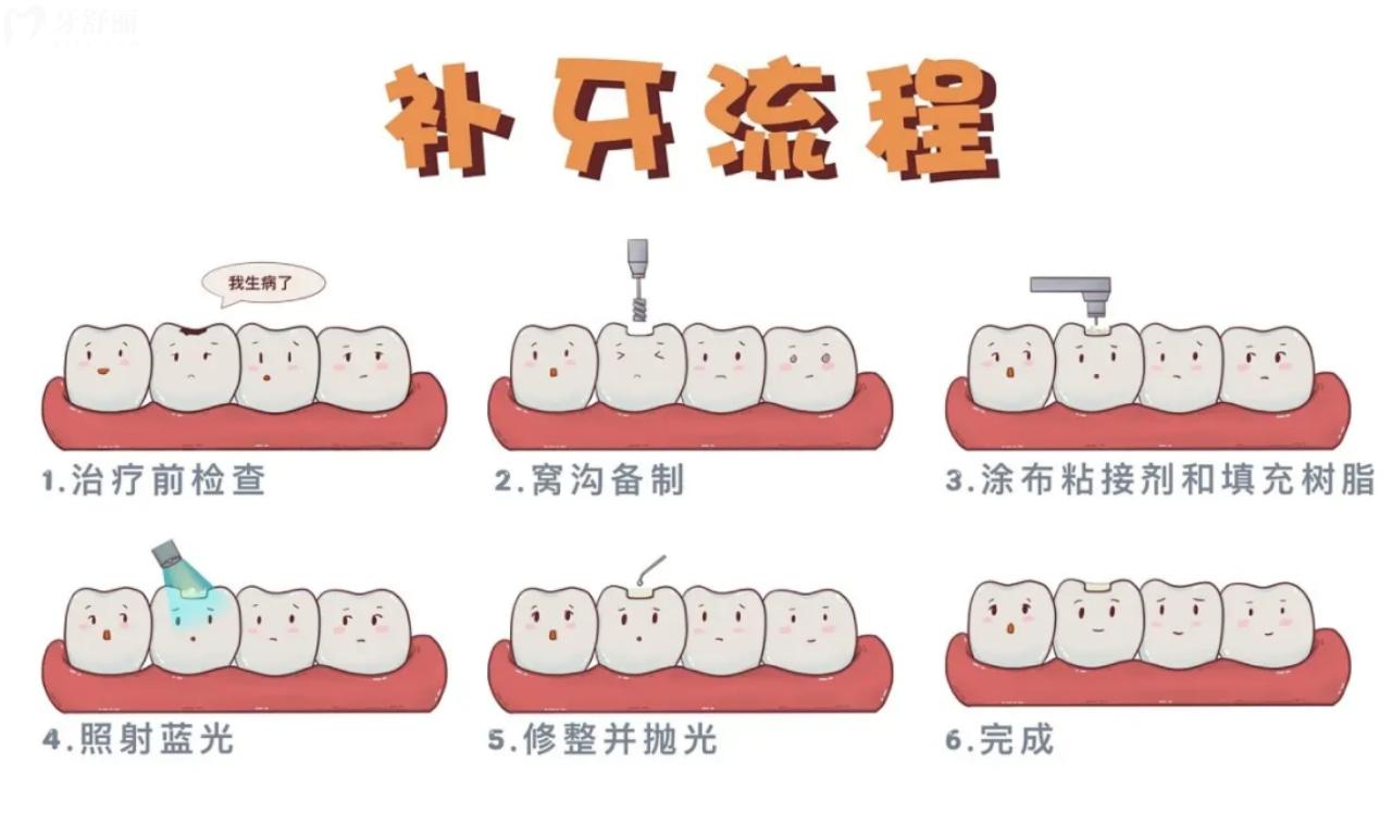 常规补牙流程图解