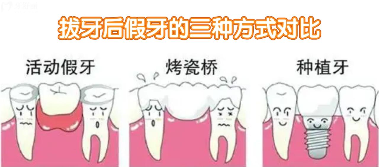 缺牙后的三种假牙方式