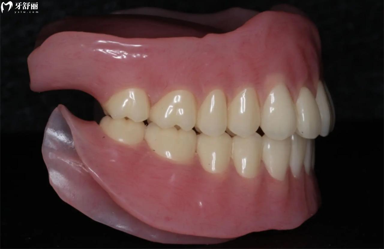 BPS全口吸附性假牙