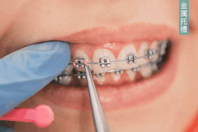 不同形式的牙齿矫正方法