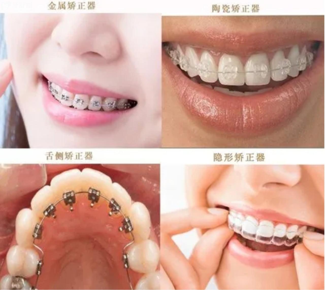 牙齿矫正的不同方式