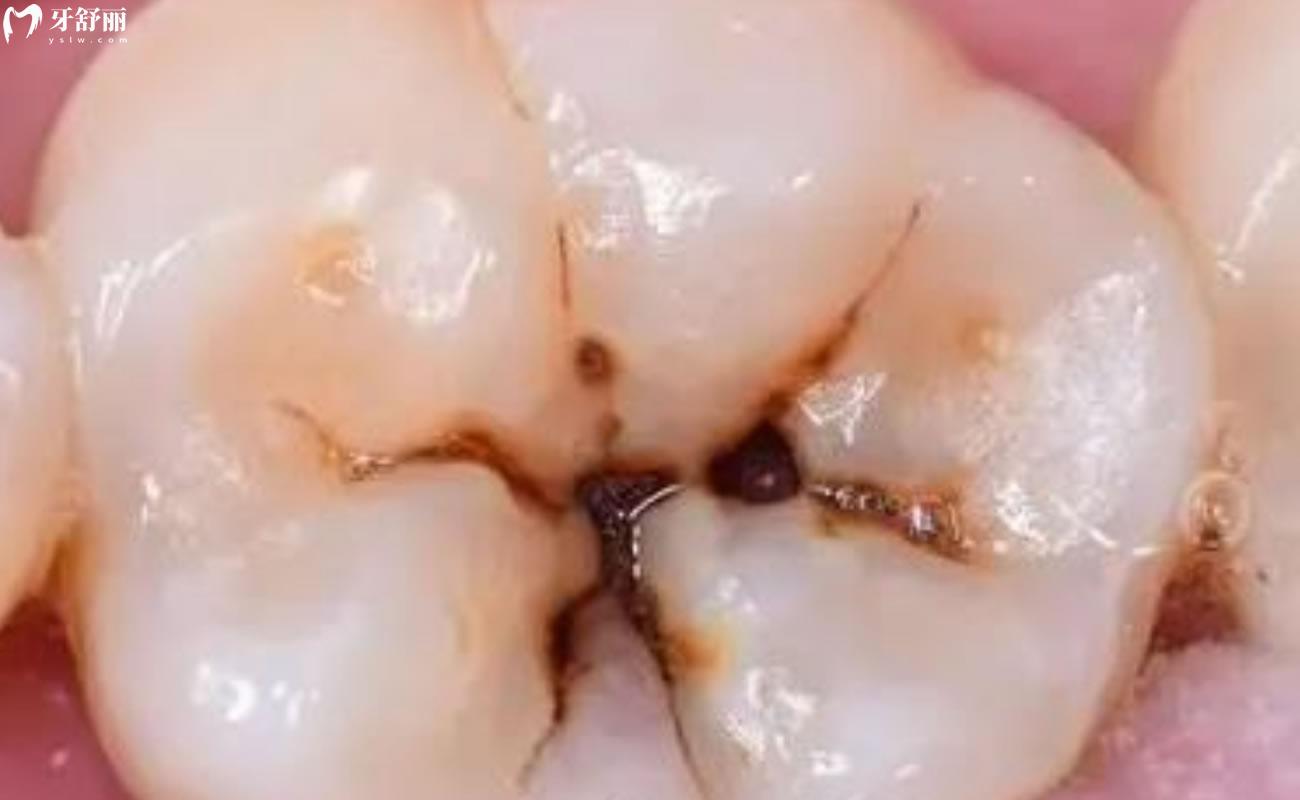 蛀牙的虫子长啥样图片