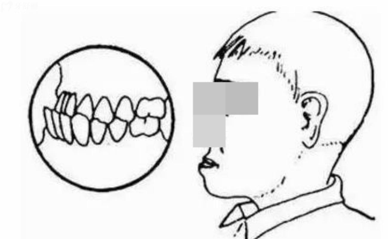 怎么判断地包天是骨性还是牙性