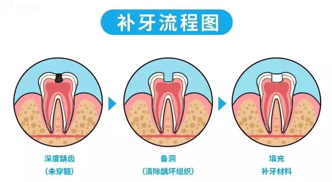 补牙过程图