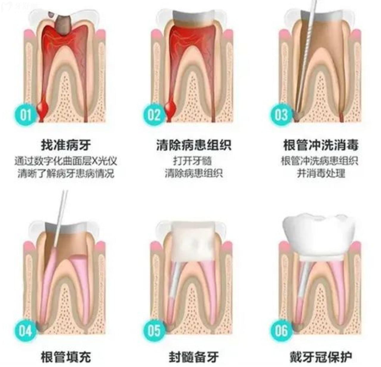 根管治疗