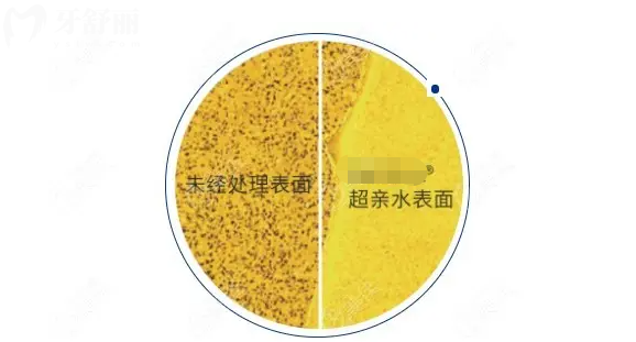 尼奥斯neoss种植能用多长时间 亲水植体是智商税吗？