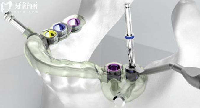 广东种植牙集采什么时候开始 直接告诉你十家实惠种牙医院 广东种植牙集采什么时候开始 直接告诉你十家实惠种牙医院