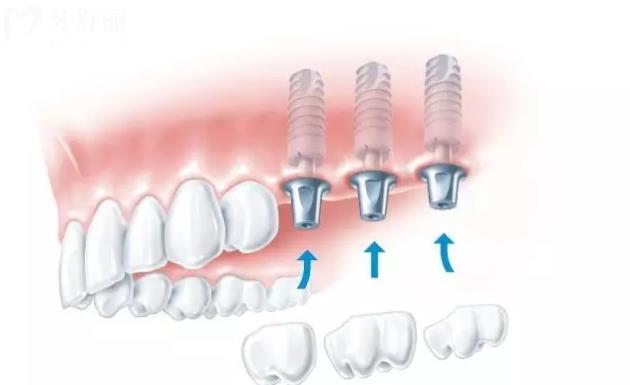 广东种植牙集采什么时候开始 直接告诉你十家实惠种牙医院 广东种植牙集采什么时候开始 直接告诉你十家实惠种牙医院