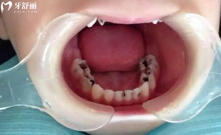 宝宝蛀牙早期症状