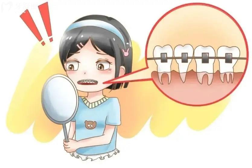 上海九 院牙齿矫正是一次性付费吗多少钱,掩饰性正畸谈一下感受