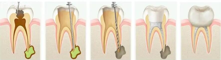 做过根管治疗的牙齿多久可以吃辣