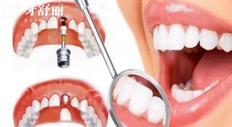 广西种植牙集采什么时候开始 不要错过正规便宜种牙口腔医院