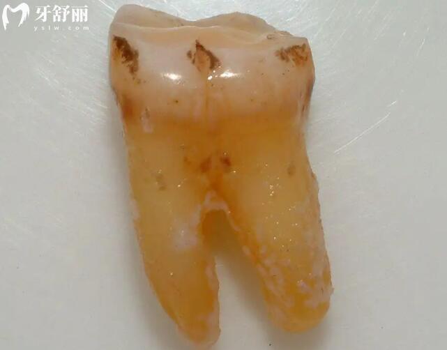 拔牙后多久可以种植牙根和牙冠图片大全