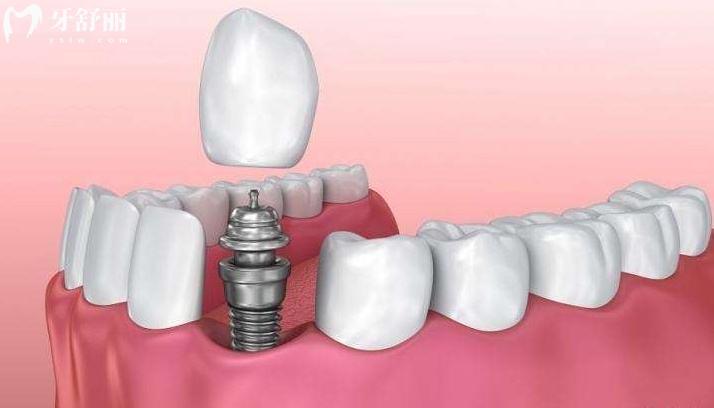 安联种植牙是几级钛，安联种植牙可以维持多久