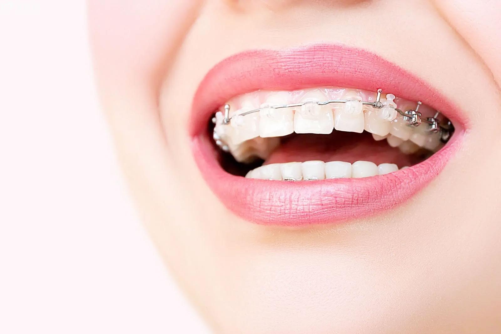 五,牙齿矫正方案应包括哪些内容