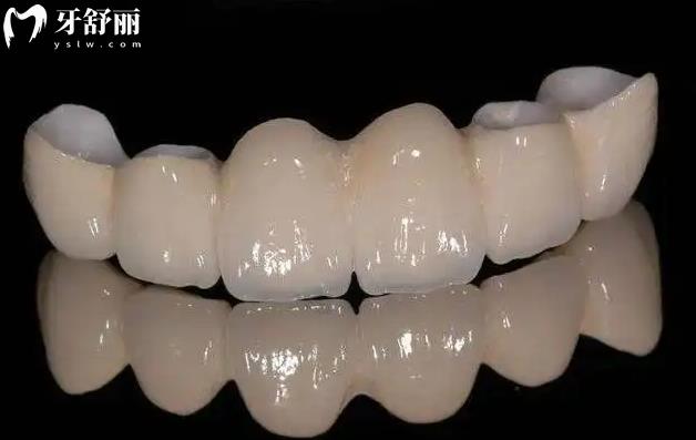 全瓷牙 全瓷牙