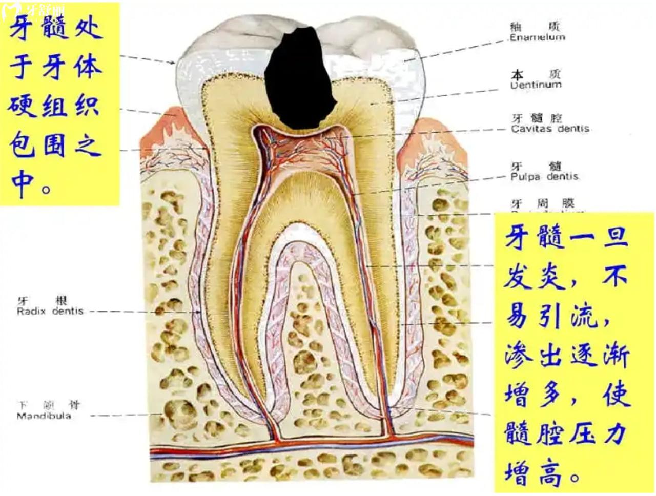 什么是牙髓炎