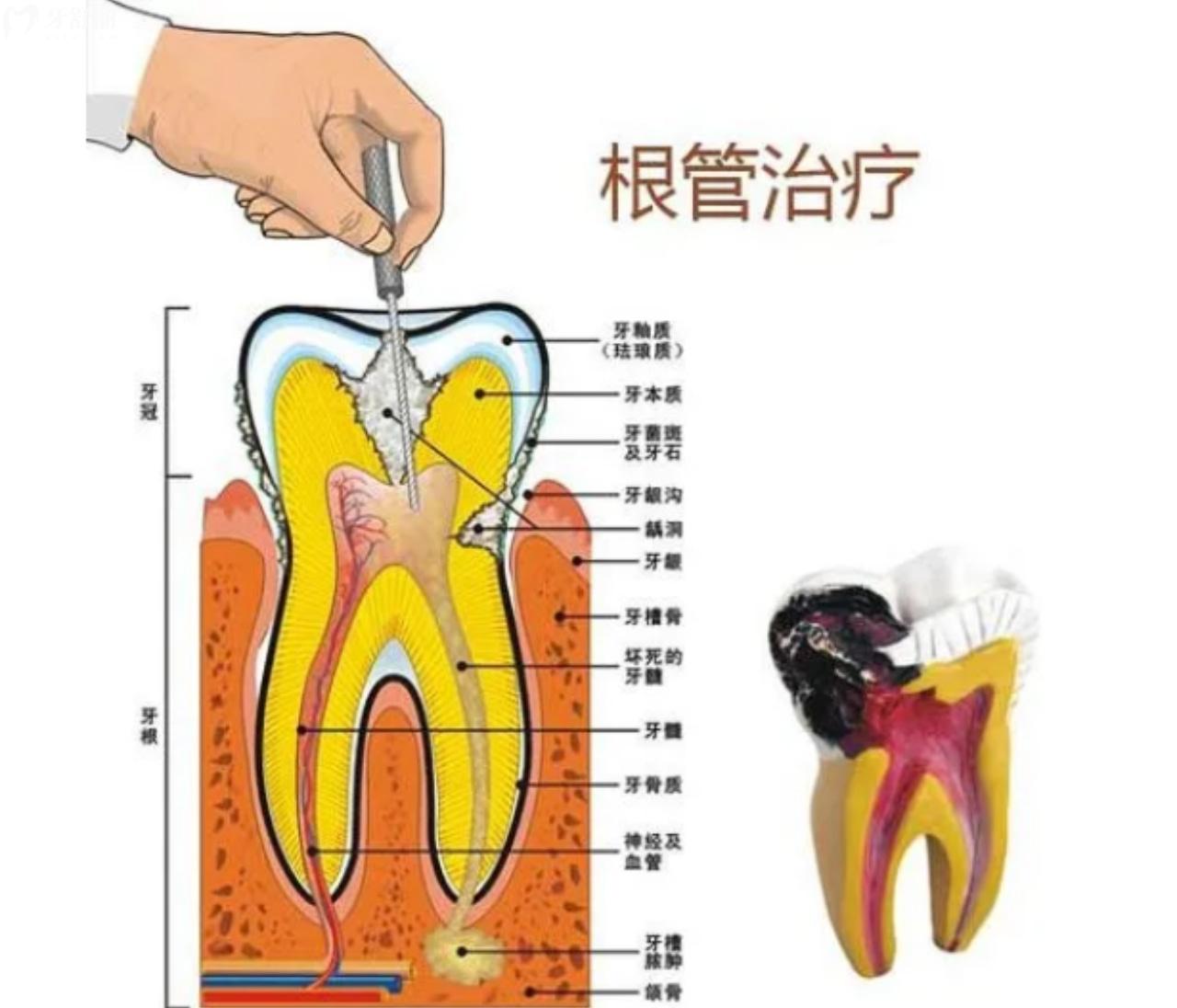 根管治疗