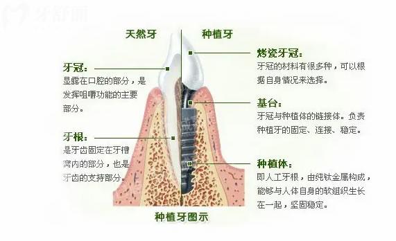 种植牙结构图
