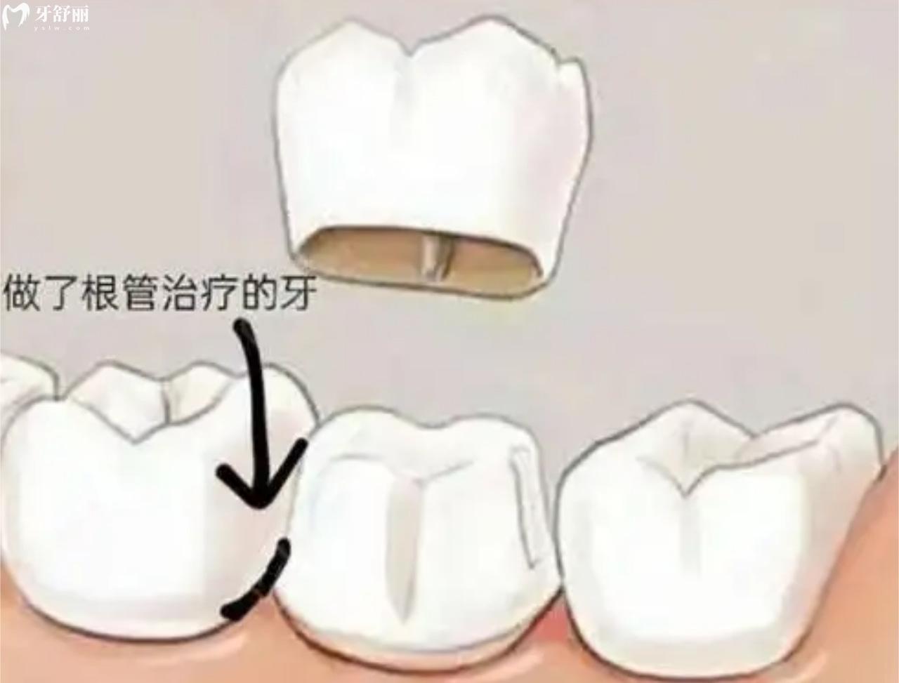 做过根管治疗的牙需要戴牙冠