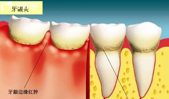牙医都不告诉你的种植牙危害 盘点种牙五大副作用