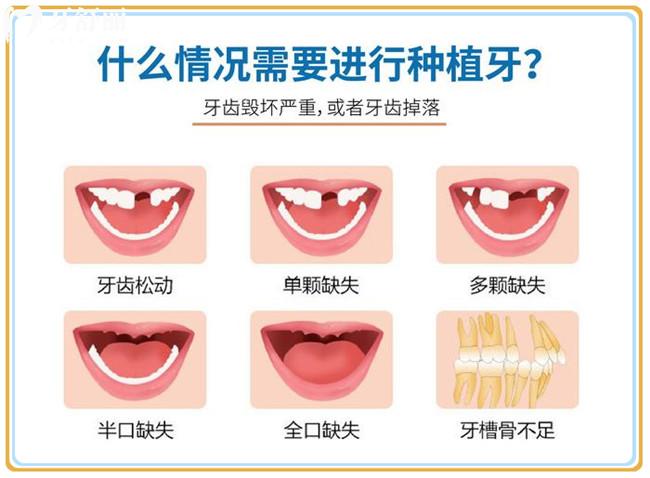 什么情况需要种植牙