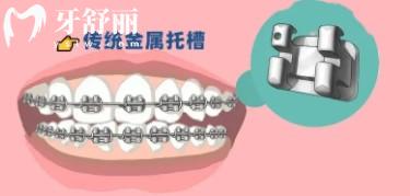牙齿矫正会变牙套脸？带牙套1~12月变化图