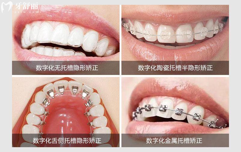 牙齿矫正不同方式