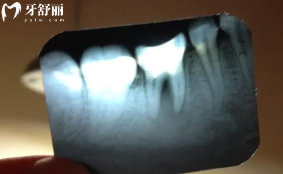 看牙前的检查太费钱了有必要做吗 其实这些牙科项目不用拍片