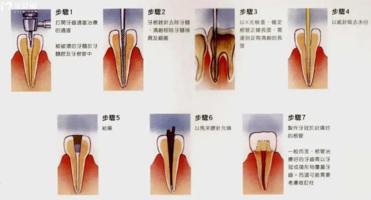 根管治疗过程