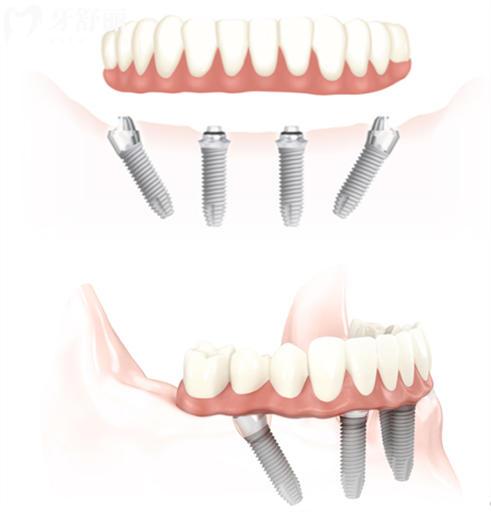 2万块能种全口牙吗？盘点半口全口牙是怎么修复的？