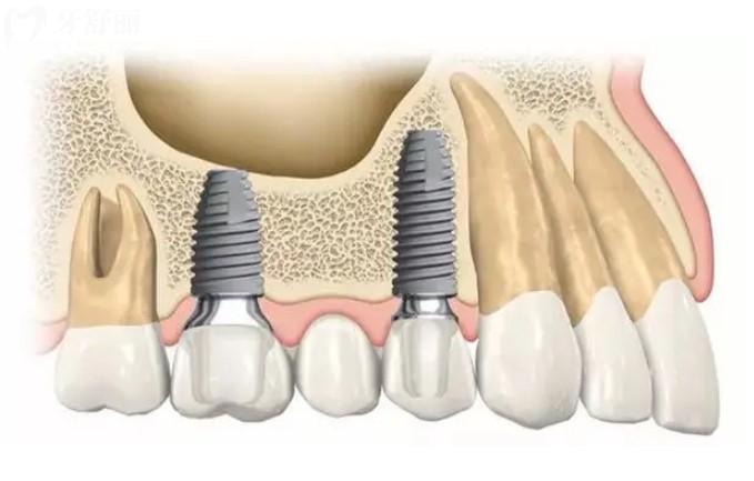 种植牙图
