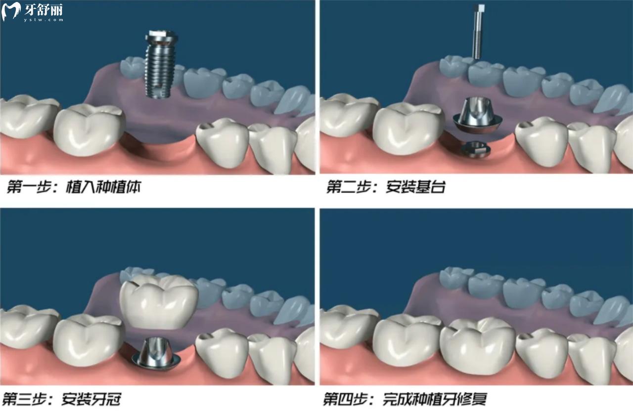 种植牙流程手术