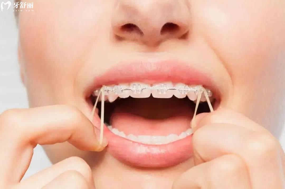 带牙套为什么会出现牙套脸，带橡皮筋是什么感觉？