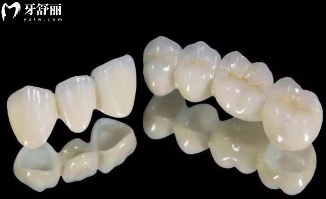 全瓷牙 全瓷牙