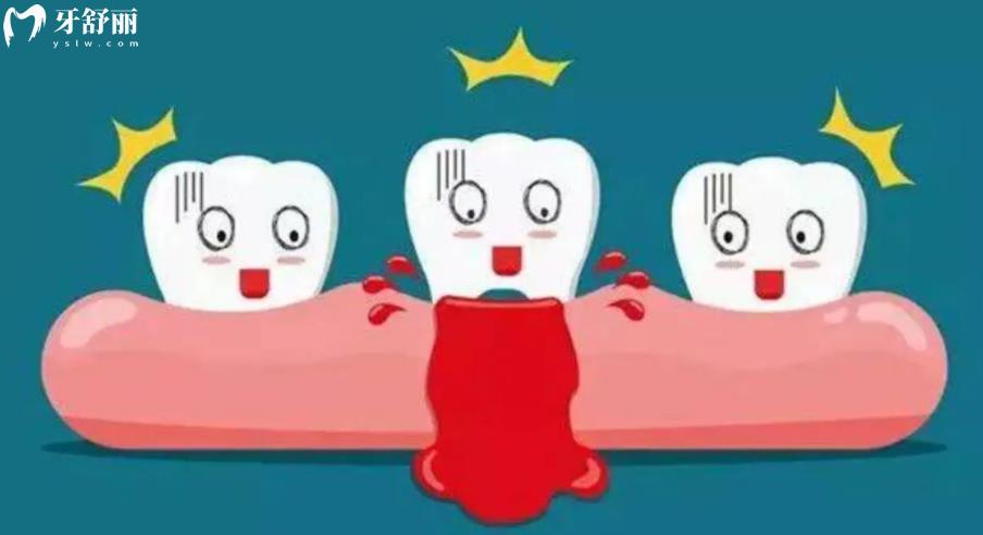 不知道牙龈经常出血是什么原因 原来是这些常见小习惯