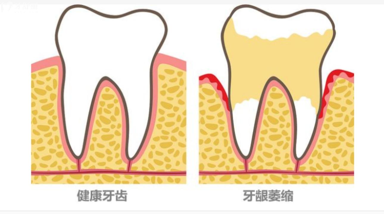 牙龈萎缩牙根外露怎么治疗?什么原因造成的?