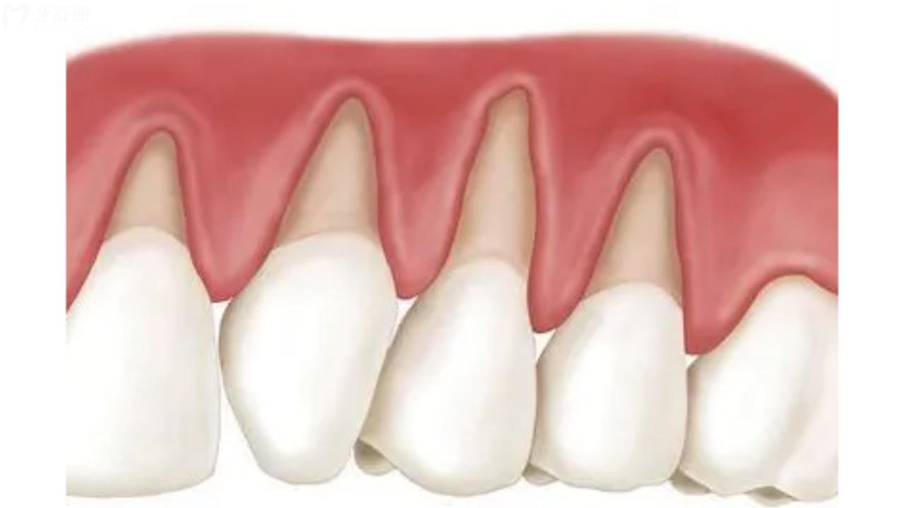牙龈萎缩牙根外露怎么治疗?什么原因造成的?