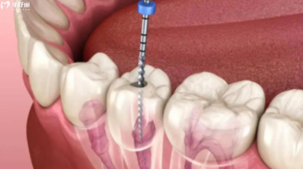 去除牙神经的过程很痛吗?牙神经去除和根管治疗的区别!