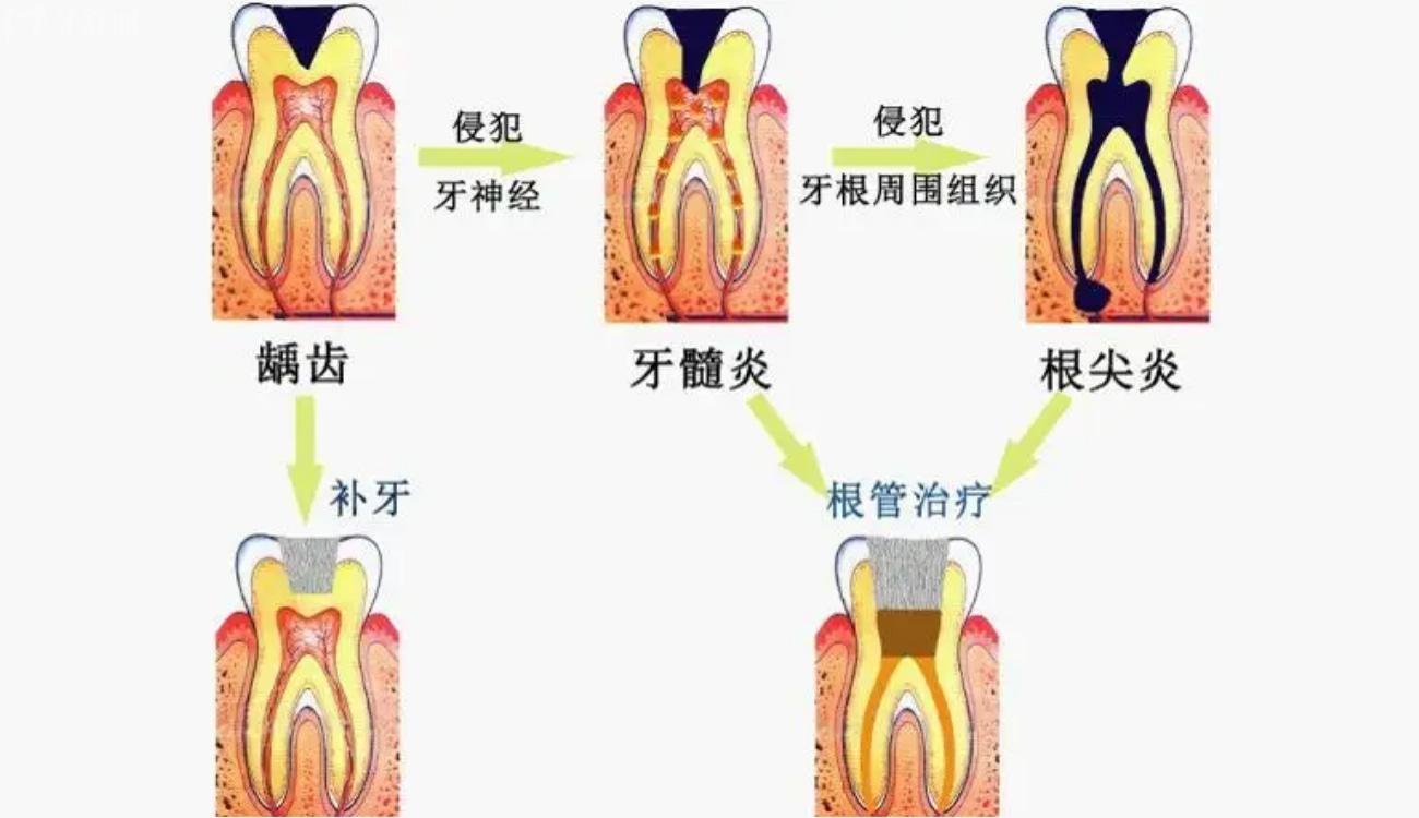 牙髓炎的临床症状和防治原则.jpg